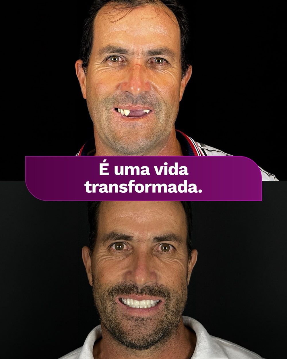 Antes e depois de paciente da Oral Unic Tubarão: ausência de dente frontal e sorriso reabilitado após o tratamento